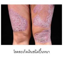 การปฏิบัติตัวเมื่อเป็นโรคสะเก็ดเงิน