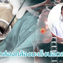 การผ่าตัดส่องกล้องมะเร็งปอดสมัยใหม่